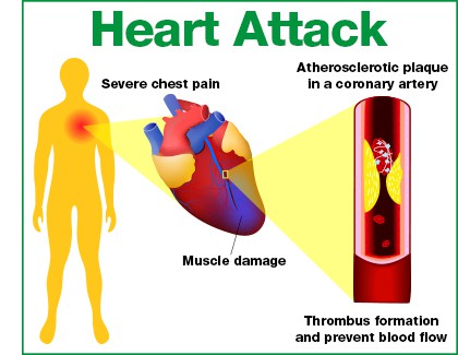 Heart attack causes severe chest pain due to heart muscle damage, as build-up in artery prevents blood flow to the heart